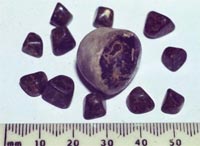 Gall Bladder Stones