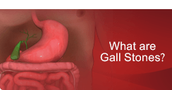 What are Gall Stones - Mr.Andrew Jenkinson - GALL BLADDER SURGERY London